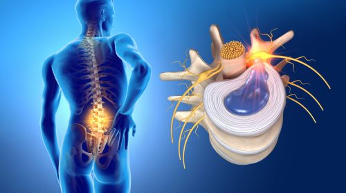 Herniated-Disc-scaled