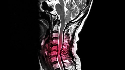 cervical-spinal-2