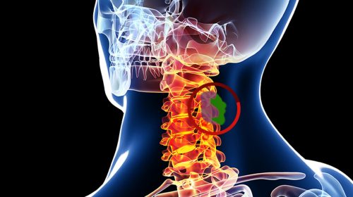 spinal-tumors