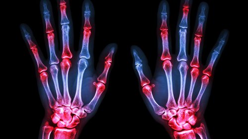 treating-RA-at-each-stage