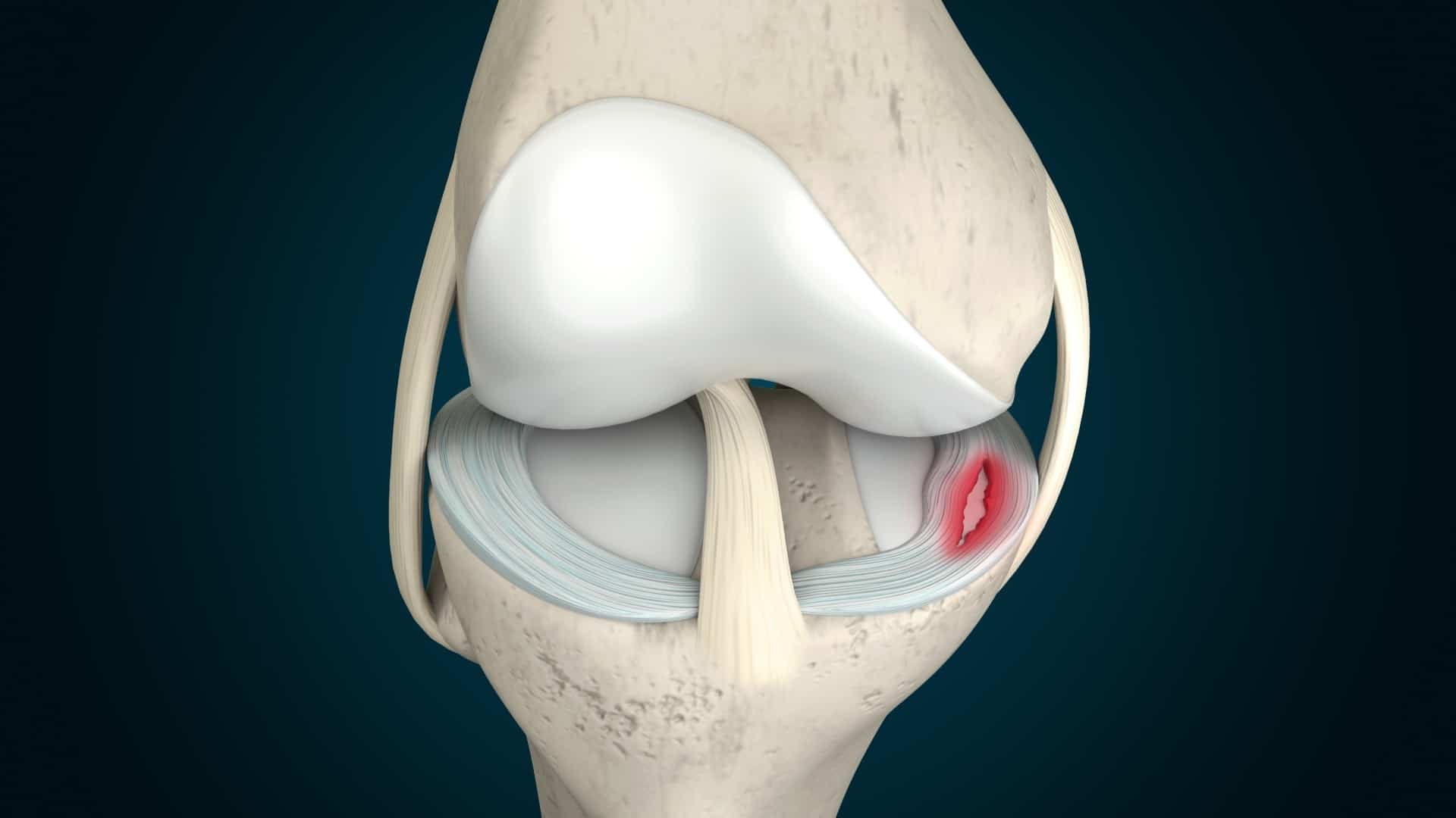 3D-rendering-of-meniscus-tear