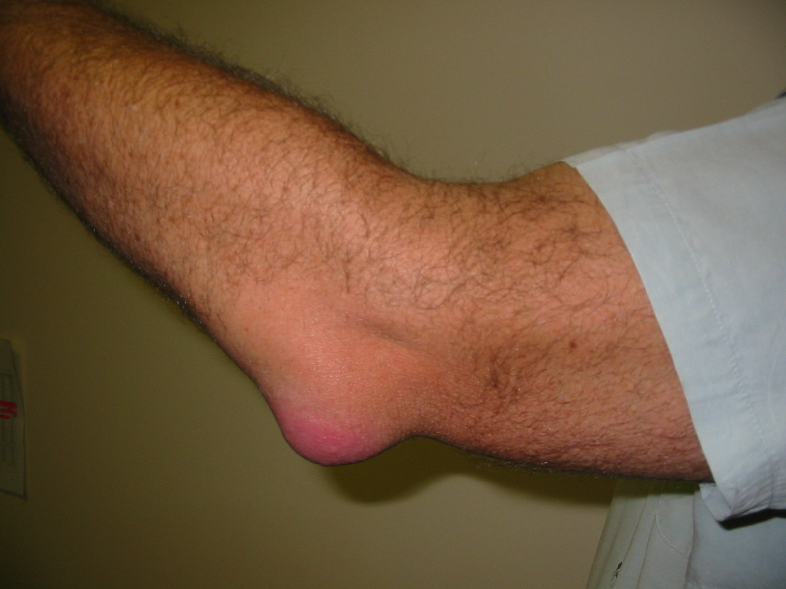 Bursitis_Elbow_WC