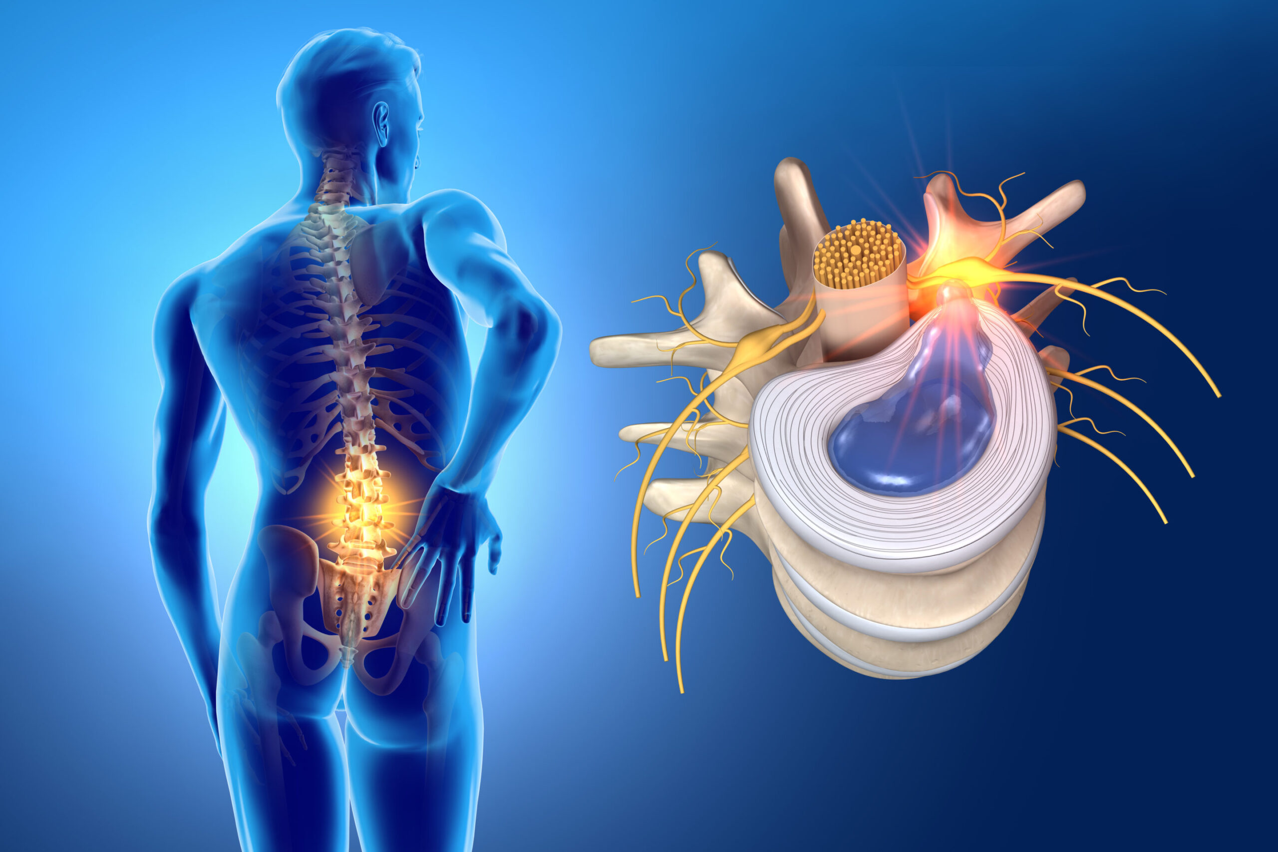 Herniated-Disc-scaled