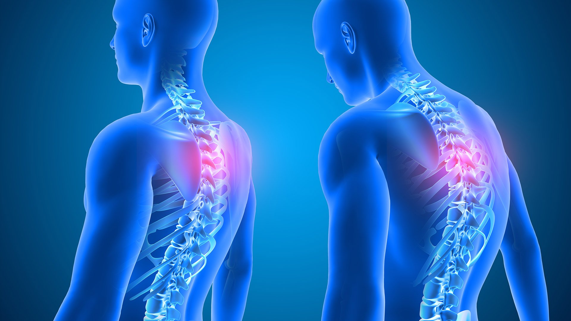 Kyphosis