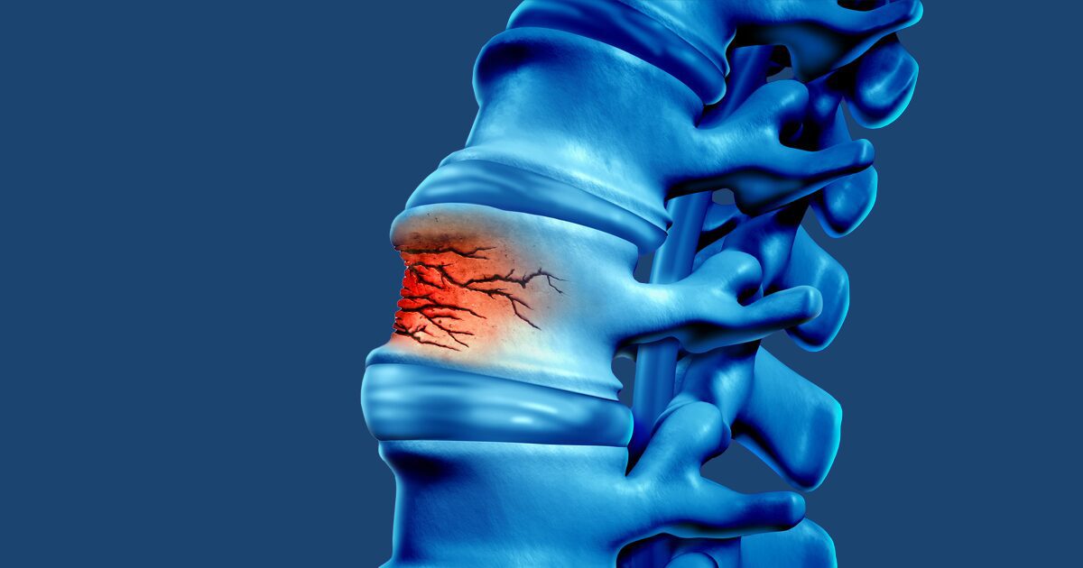 Osteoporotic-Compression-Fractures