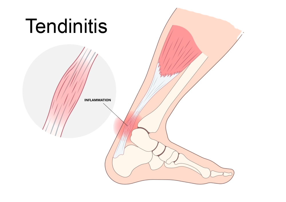 What-is-Tendinitis