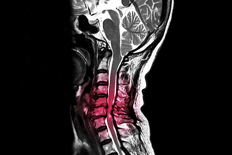 cervical-spinal-2