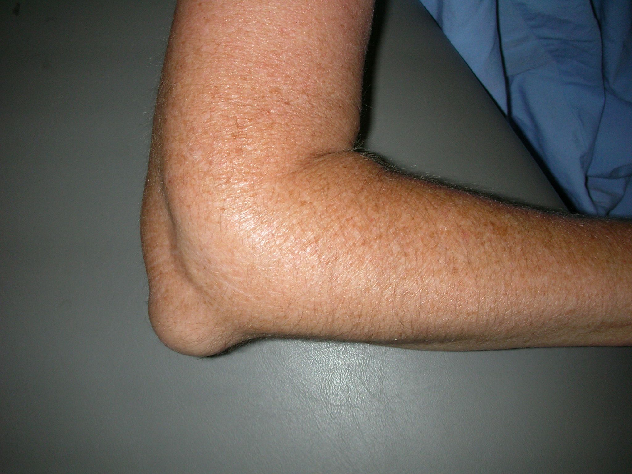 compr_olecranonbursitis_photo