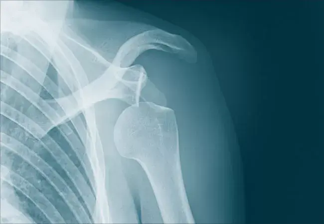 dislocatedShoulder-182240772-650x450_jpg