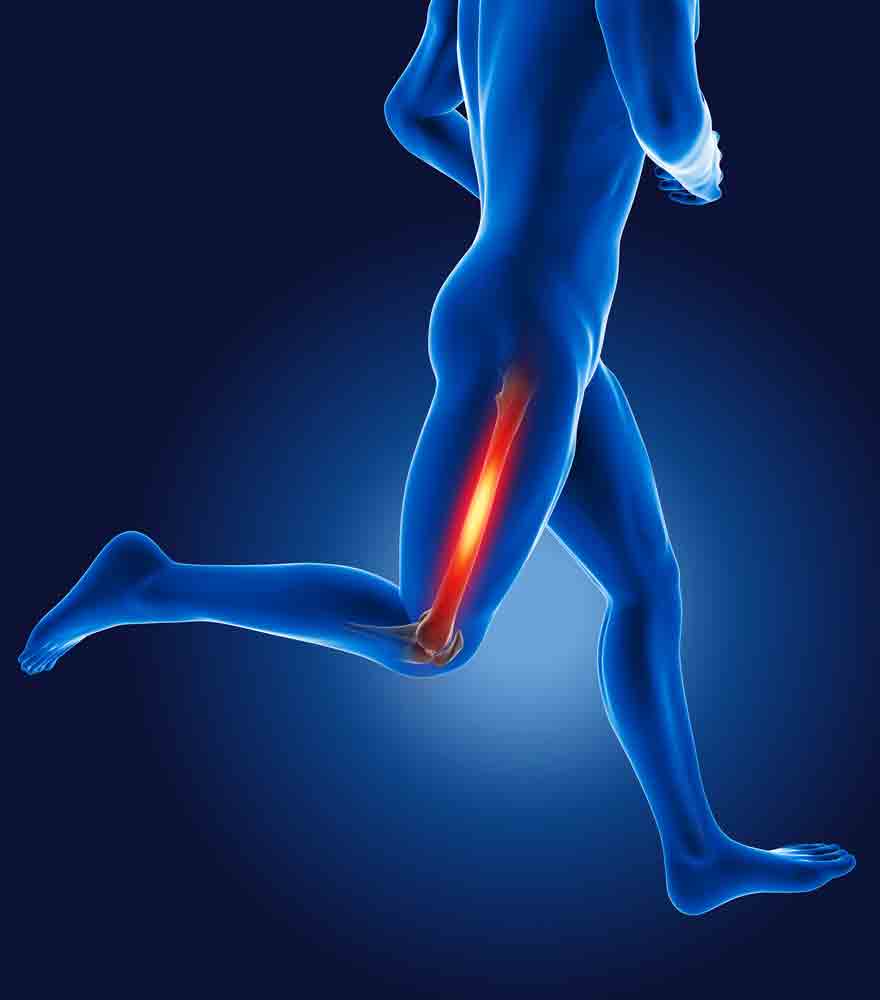 running-leg-pain-physical-therapy-oakland-128648288-1