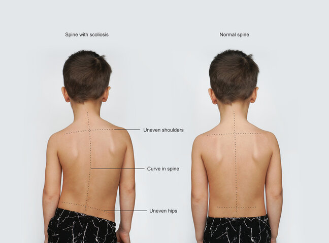 signs-of-scoliosis