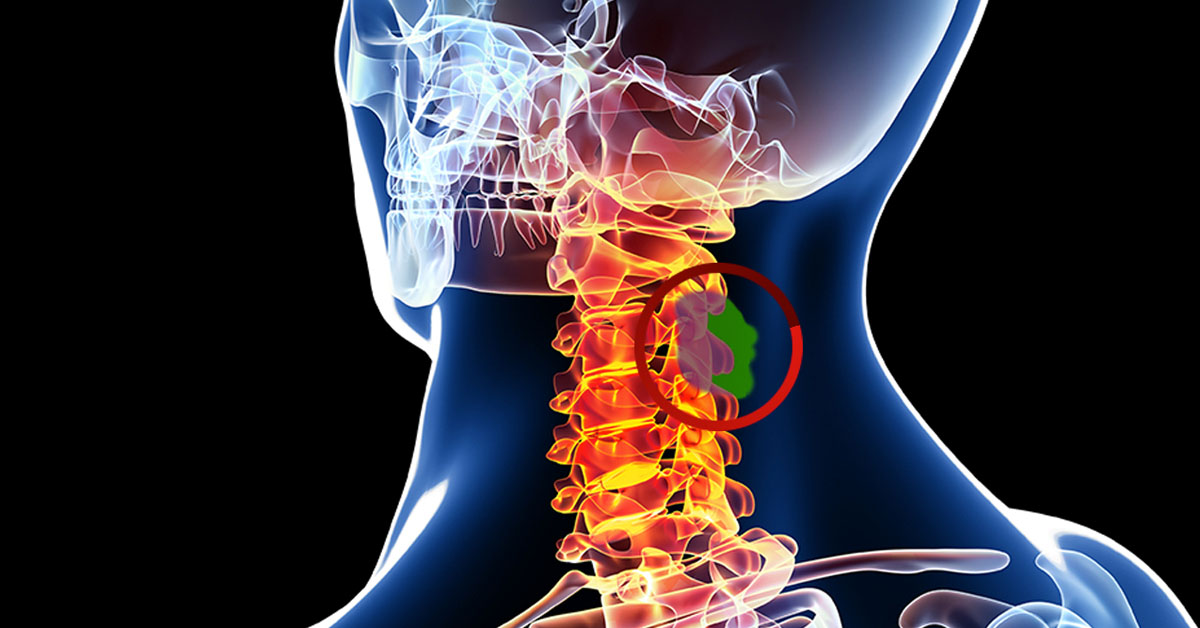 spinal-tumors