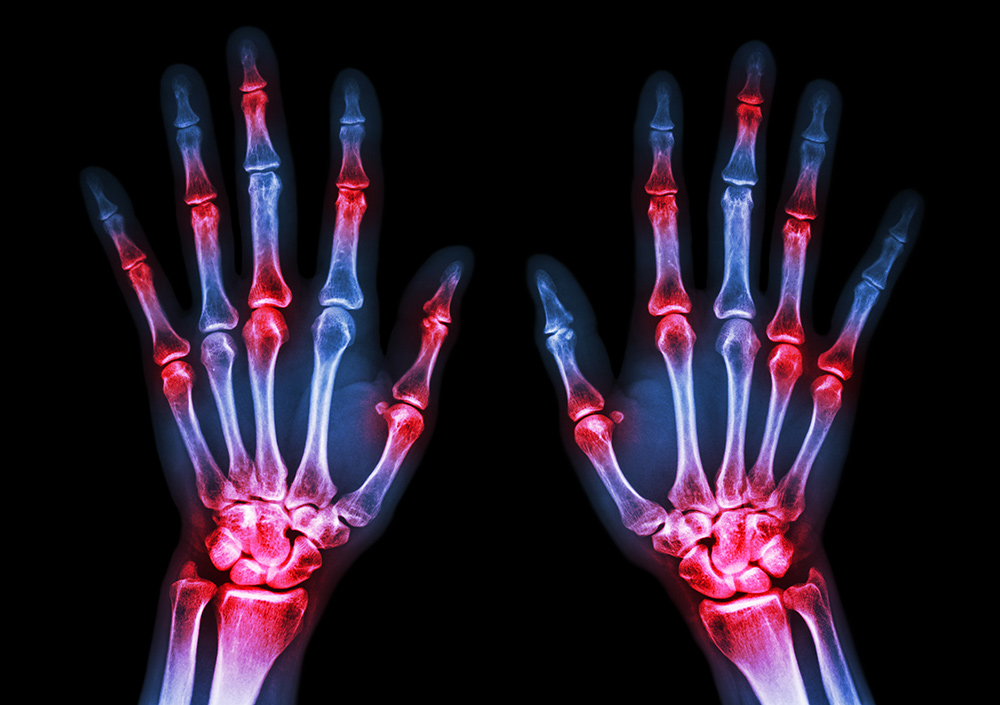 treating-RA-at-each-stage